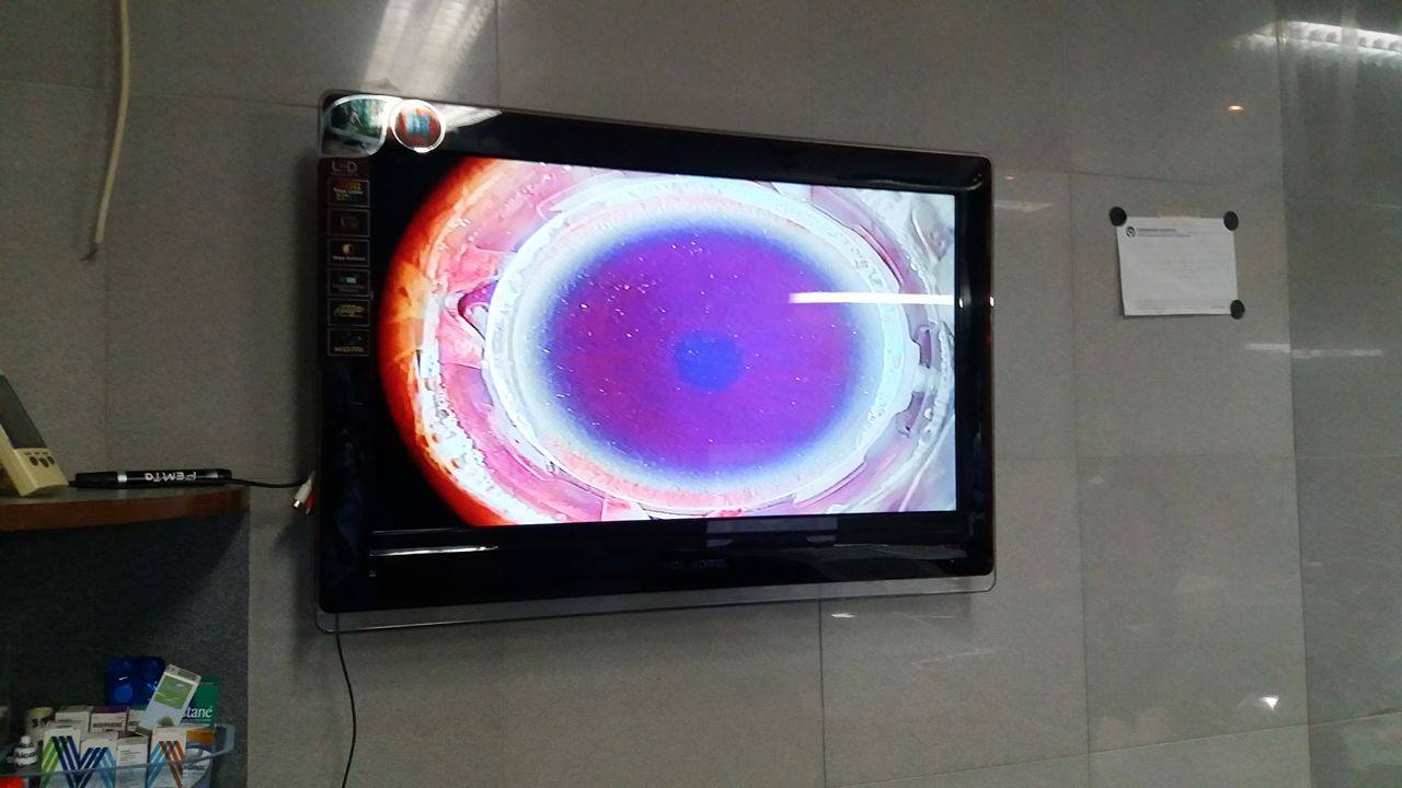Topo guided Lasik Hashmanis 1